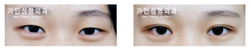 매몰법