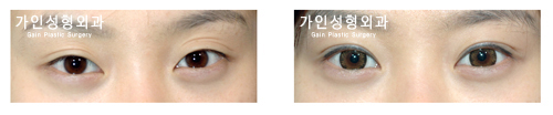 매몰법