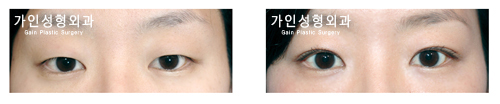 매몰법