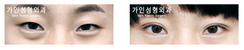 매몰법
