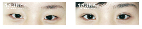 매몰법