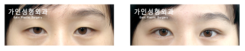 매몰법
