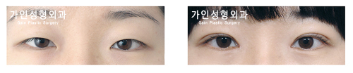 매몰법앞트임