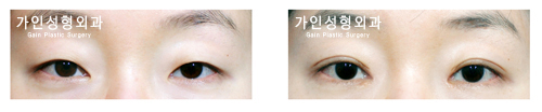 매몰법앞트임