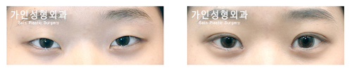매몰법앞트임