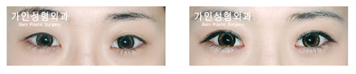 매몰법앞트임