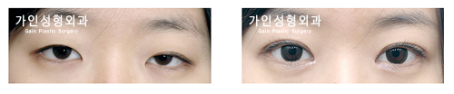 매몰법앞트임