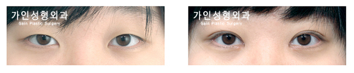 매몰법앞트임