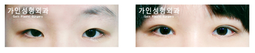 매몰법앞트임