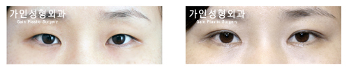 매몰법앞트임