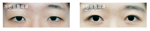 매몰법앞트임