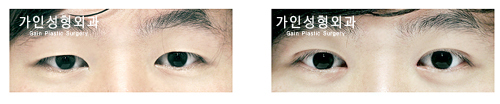 매몰법앞트임