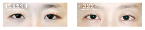 매몰법앞트임