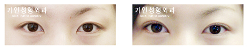 매몰법앞트임