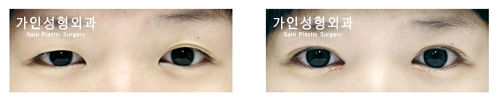 매몰법앞트임
