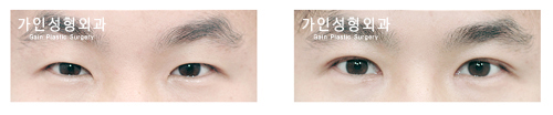 매몰법앞트임
