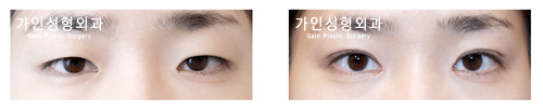 매몰법앞트임