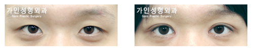 매몰법앞트임