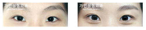 매몰법앞트임