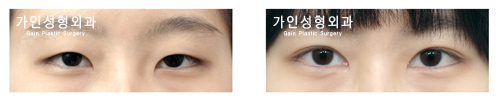 매몰법앞트임