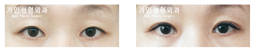 눈매교정 / 앞트임