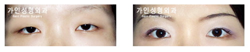 안검하수 / 앞트임