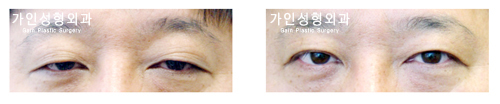 안검하수