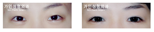 부분절개