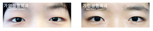 부분절개 + 앞트임