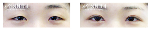부분절개 + 앞트임
