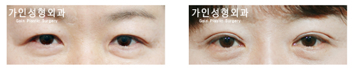 상안검