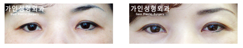 상안검