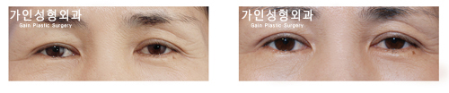 상안검