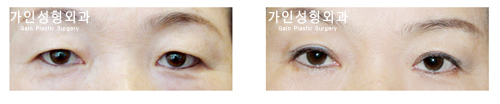 상안검