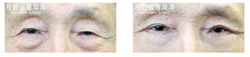 상 + 하안검