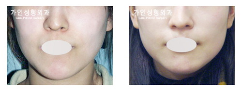 팔자+볼지방주입