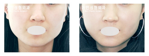 팔자+볼지방주입