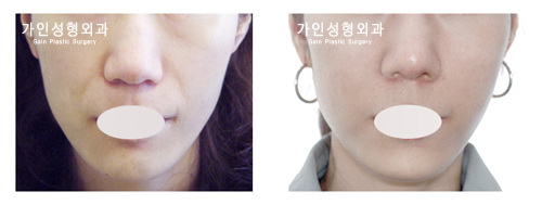 팔자+볼지방주입