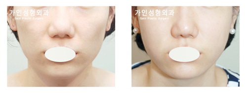 팔자+볼지방주입