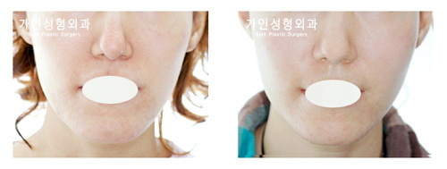 팔자+볼지방주입