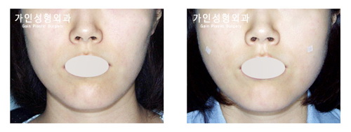 팔자+볼지방주입