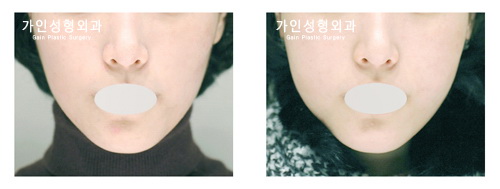 팔자+볼지방주입