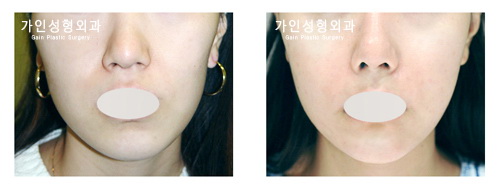 팔자+볼지방주입