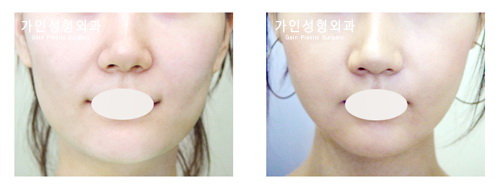 팔자+볼지방주입