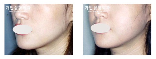 팔자+볼지방주입