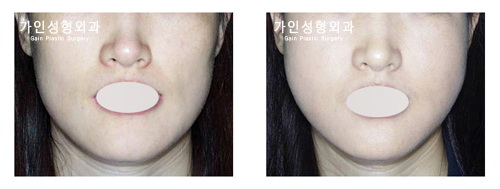 팔자+볼지방주입
