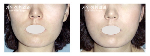 팔자+볼지방주입