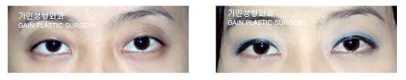 꺼진눈지방주입