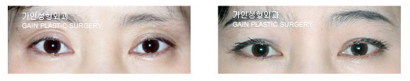 꺼진눈지방주입