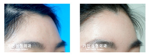 이마지방주입